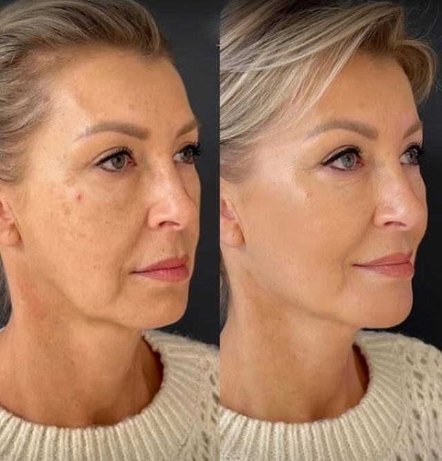 Major skin improvement after 5 sessions of home skincare combined with MAX and LED treatments.